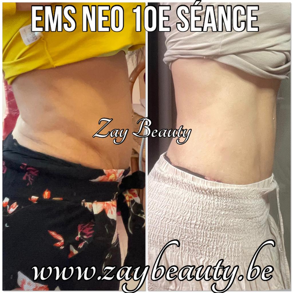 Ems Neo ems emsculpt, Enlèvement