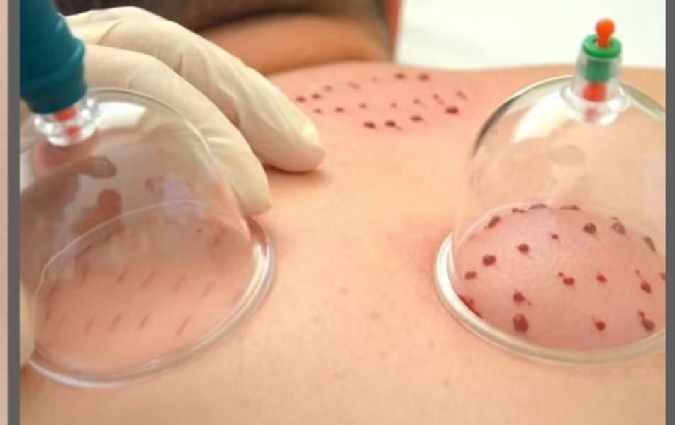 Hijama cupping thérapie pour femmes à domicile, Vacatures