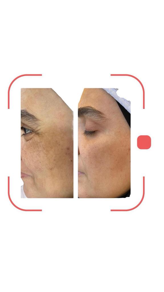 Hifu 8D, Zakelijke goederen, Overige Zakelijke goederen, Ophalen