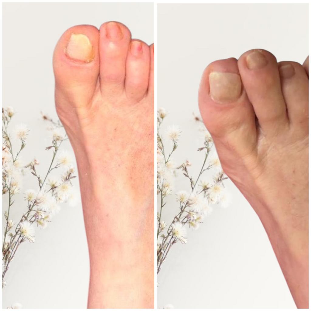 Pédicure medicale, Ophalen