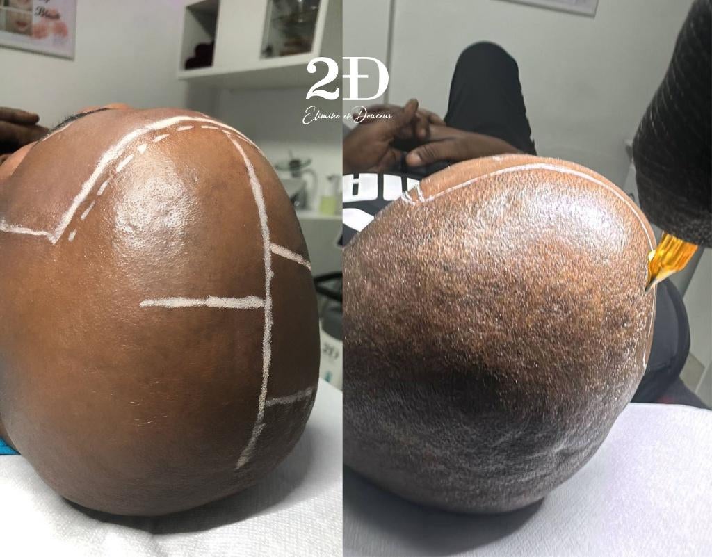 MicroPigmentation capillaire à Bruxelles, Enlèvement, Neuf, Tondeuse